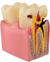 ($32) Dental Tooth Decay Model 6 Times