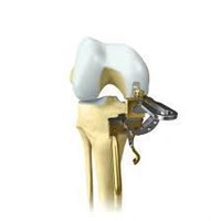 BIOMET OXFORD PARTIAL KNEE MICROPLASTY 159544