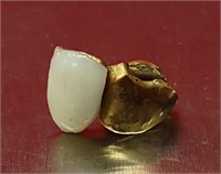 Gold Filling W/Tooth Still Attached