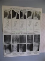 2 posters of Spinal Degeneration