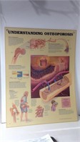 1993 Anatomical Chart "Osteoporosis"  U15D
