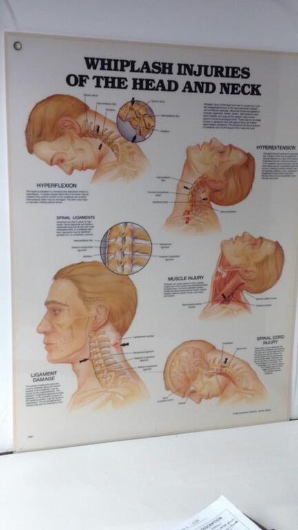 1990 Anatomical Chart " Whiplash". U5D